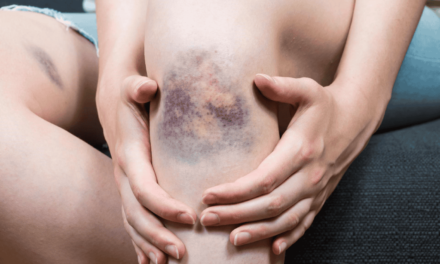 Estresse pode causar hematomas?