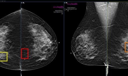IA aumenta chances de detecção de câncer de mama em 20%